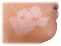 Råd om vitiligo hos Vallentuna Husläkargrupp i Vallentuna